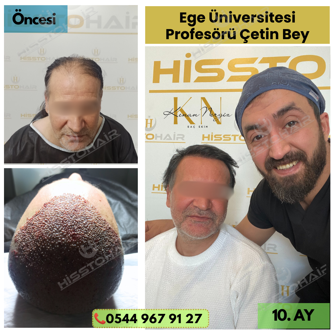 İzmir Aliağa Saç Ekim Fiyatları