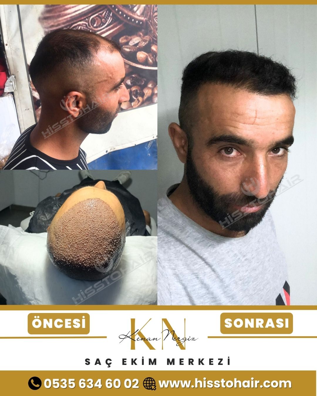 İzmir Foça Saç Ekim Sonuçları