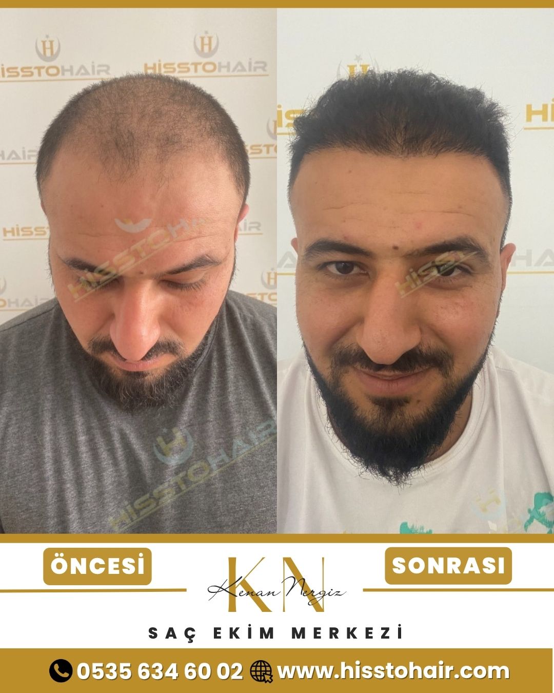 İzmir Foça Saç Ekim Sonuçları