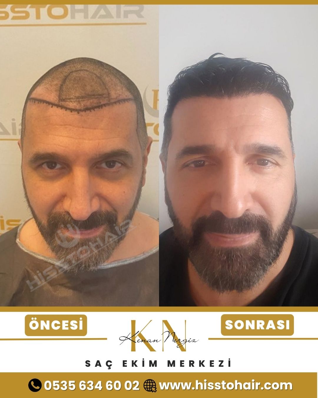 İzmir Foça Saç Ekim Sonuçları