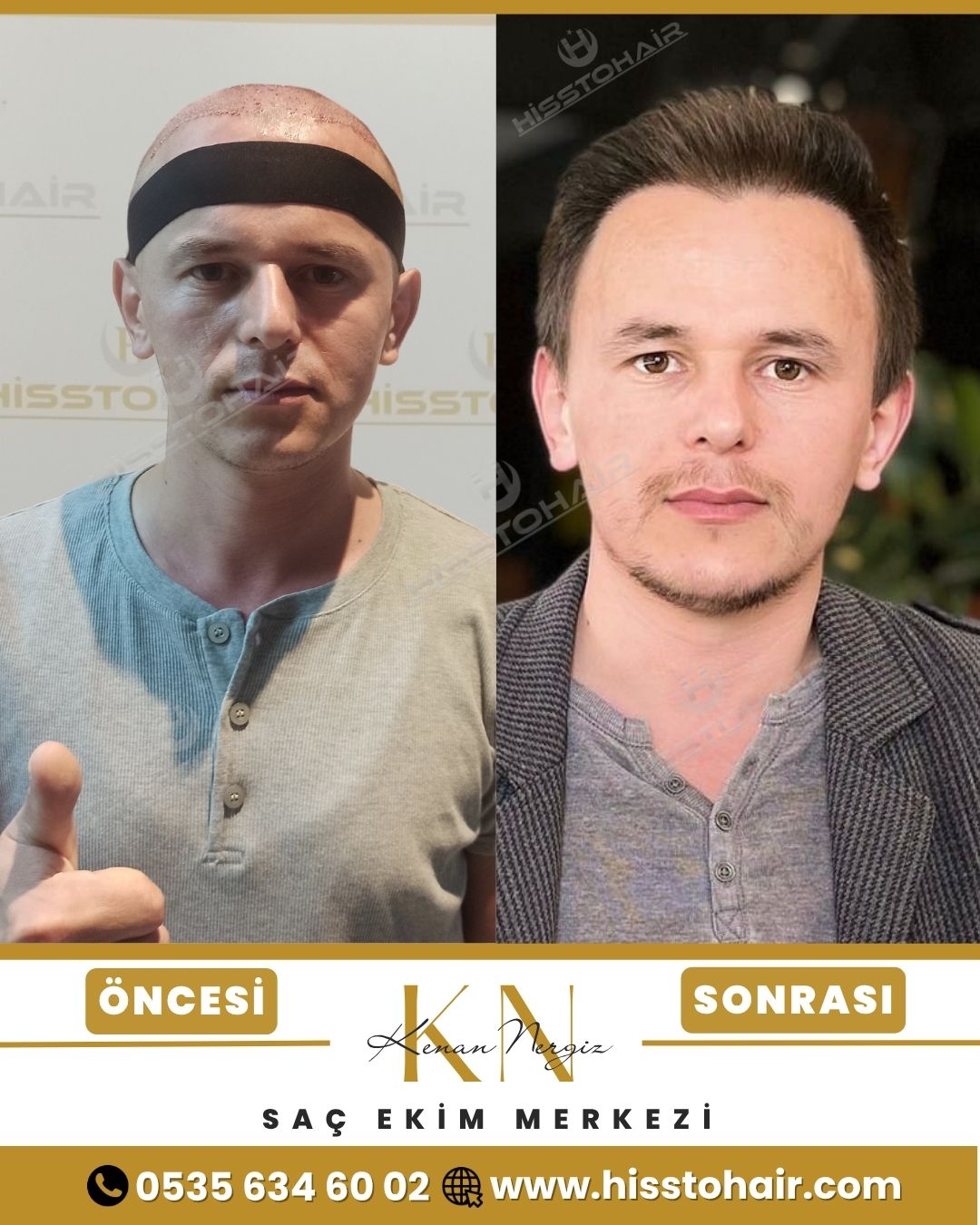 İzmir Foça Saç Ekim Sonuçları