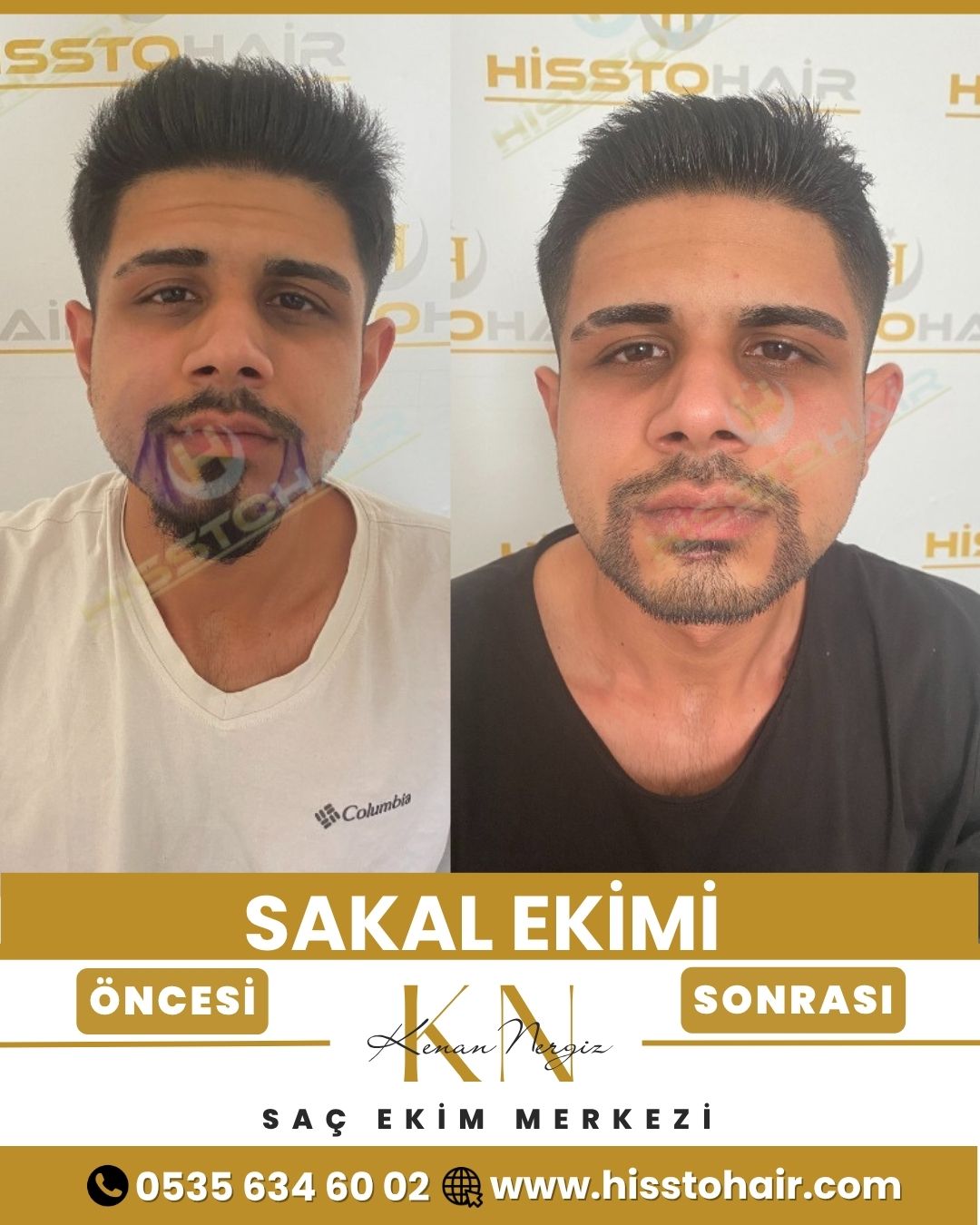 İzmir Foça Saç Ekim Sonuçları