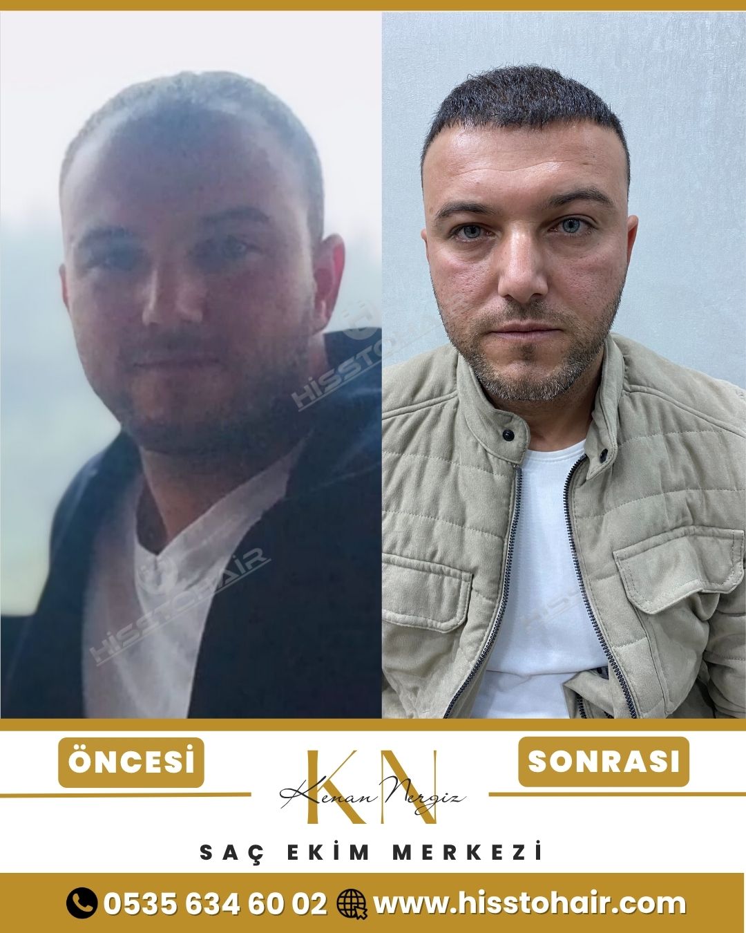 İzmir Foça Saç Ekim Sonuçları