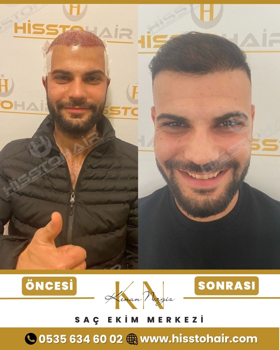 İzmir Foça Saç Ekim Sonuçları