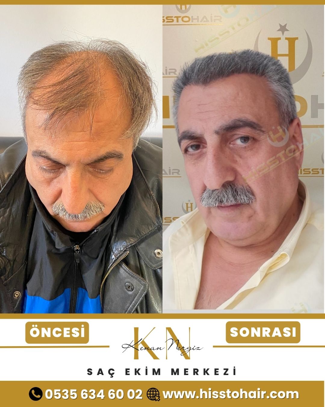 İzmir Foça Saç Ekim Sonuçları